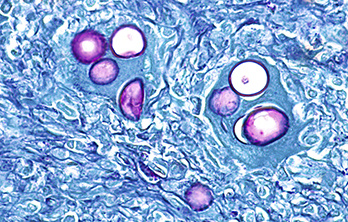 Coccidiosis in poultry: anticoccidial global market and trends