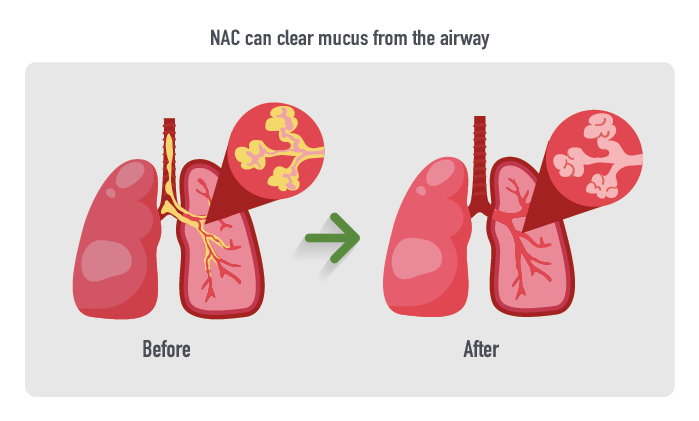 NAC can clear mucus from the airway